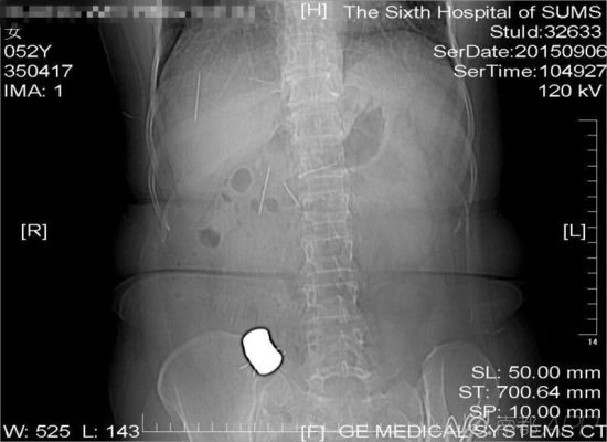 廣西女子為治腹痛吞下10根針9塊磁鐵