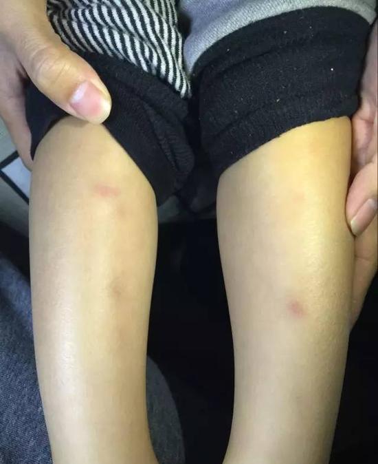 天津一幼兒園被曝“針扎兒童” 因孩子沒按時睡覺